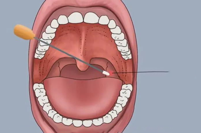 口咽拭子采集口腔样本图解