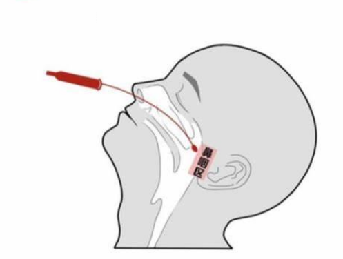 鼻咽拭子采集示意图