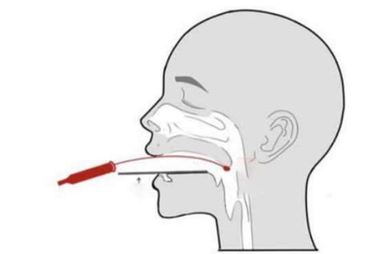 口咽拭子采集示意图